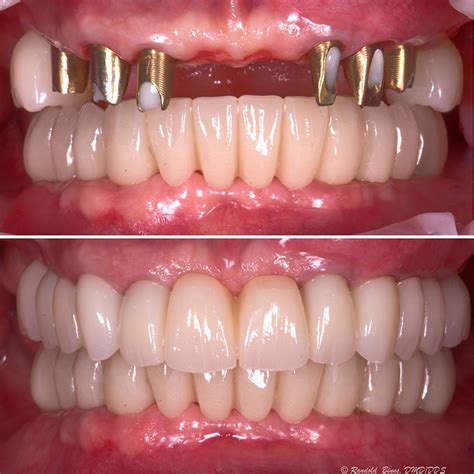 Before & After - Advanced Prosthodontics & Implant Aesthetics | Naples FL