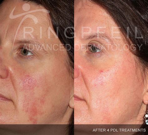 Vbeam Laser Rosacea Before And After - The Best Picture Of Beam