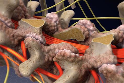 Lumbar Laminectomy Surgery Procedure Steps