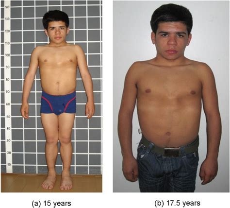 3-M syndrome associated with growth hormone deficiency: 18 year follow ...