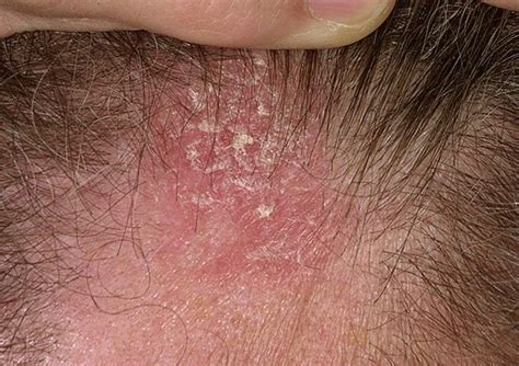 Causes Of Scalp Dermatitis & How To Treat It Effectively