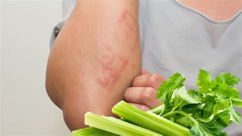 Celery Allergy, Symptoms, and How to Treat It?