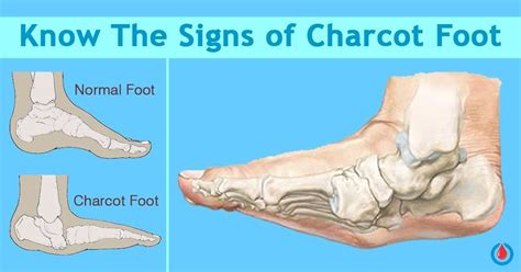 Who is at Risk of Developing Charcot Foot? - Diabetes Health Page