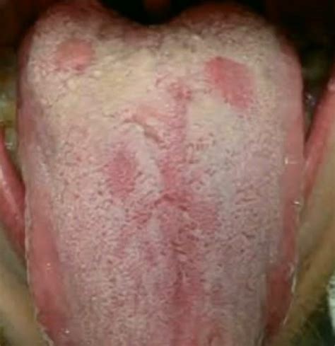 Syphilis Tongue: bumps, sores, lesion images [symptoms]