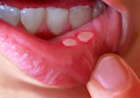 The Causes and Treatment of Mouth Ulcers: A Comprehensive Guide – Archyde