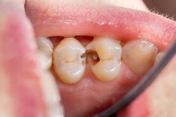 How to Choose the Right Restorative Dentistry Filling – ambrasenatore