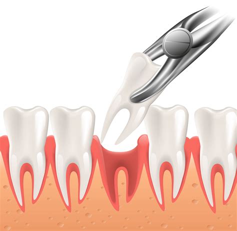 Tooth Extraction Home Care Instructions | Cobblestone Dental Care