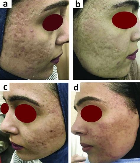 22 years old female patient had atrophic acne scar showed excellent ...