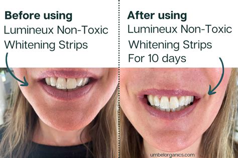 Lumineux Non-Toxic Teeth Whitening Strips Review - Umbel Organics