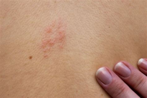 Remedies for Shingles Pain | ThriftyFun