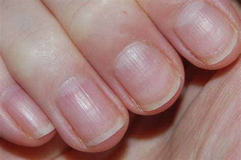 15 Health WARNINGS Your Fingernails May Be Sending