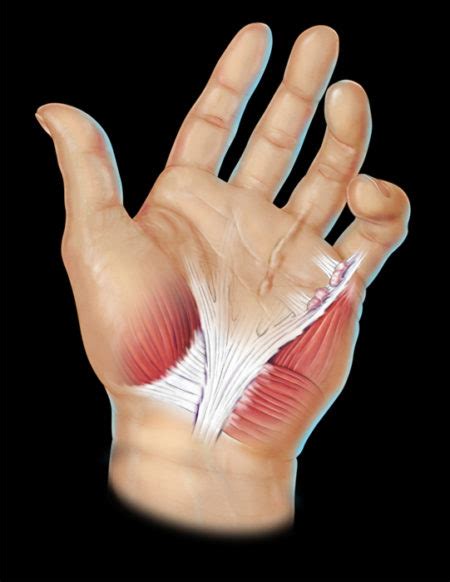 Dupuytren’s Contracture – Clark Medical Media