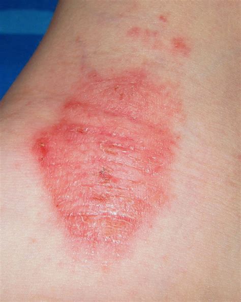 Eczema. Treatments, Help, Advice and Pictures for Mild to Extreme Cases ...