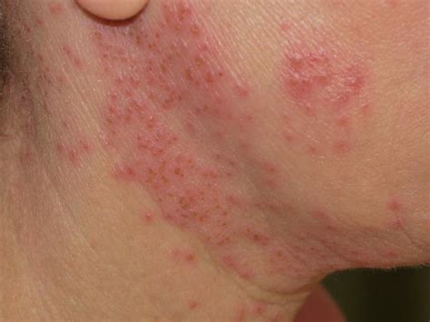 Eczema herpeticum: Symptoms, diagnosis, and treatment