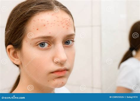 Face of a Teenage Girl with Pimples, Acne on the Skin, Concept of ...