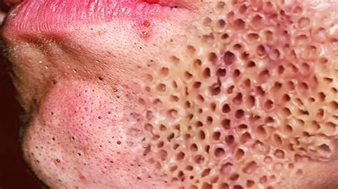 Trypophobia, Popping Pimples & Cysts or Warts! - YouTube