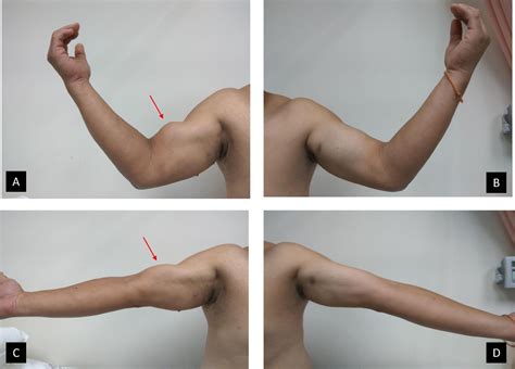 Popeye’s sign: biceps tendon rupture | BMJ Case Reports