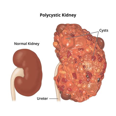 Polycystic Kidney Disease (PKD) - NIDDK