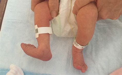 Foot Deformity at Time of Delivery in a Premature Infant | AAFP