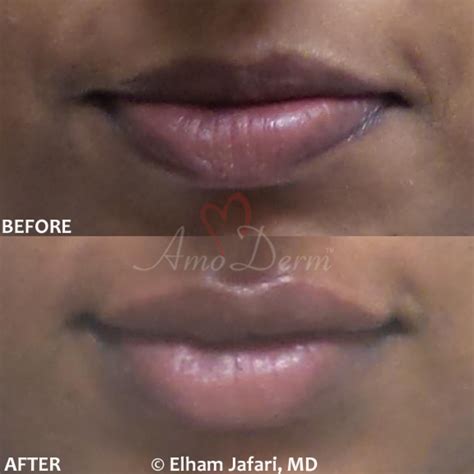 Lip Augmentation Irvine - Lip Injections, Lip Fillers, Orange County