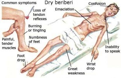 Thiamine Deficiency In Alcoholism | Rehab Guide