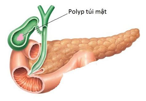 Can multiple gallbladder polyps be treated or need surgery? | Vinmec