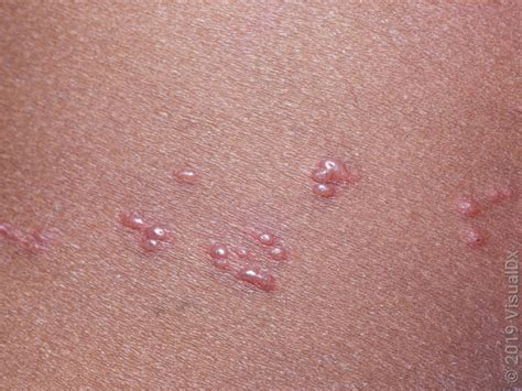 What to Expect With Shingles Rash: Early Stages and Progression - GoodRx