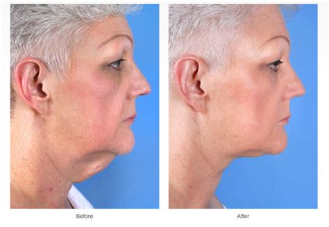 5 Reasons Neck Lift Surgery May Be Better Than Non Surgical Neck Lift ...