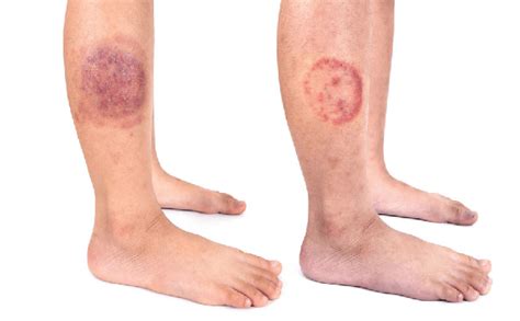 Nummular Eczema vs Ringworm: What's the Difference? - Evolving World