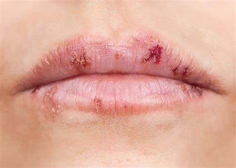 Will Shingles Occur in the Mouth? - InstantKarmaYoga