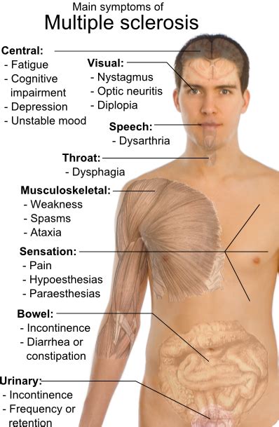 Multiple Sclerosis Symptoms And Causes >>> Health-Zine.Info