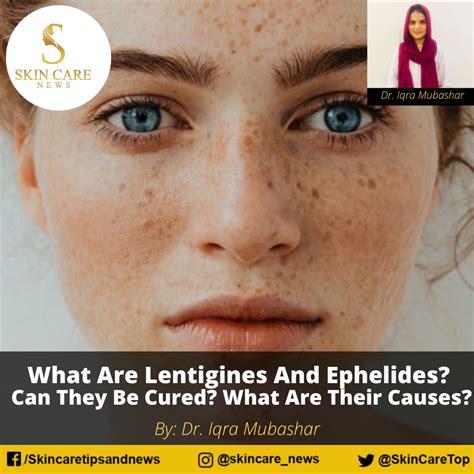 What Are Lentigines And Ephelides? Can They Be Cured?