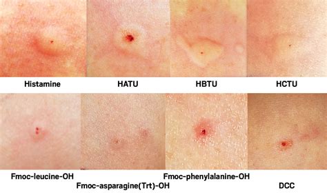 Histamine Allergy