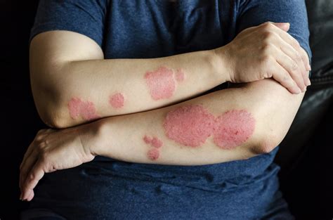 Behandling af Psoriasis: Sådan fjerner du Psoriasis – Få GUIDE her