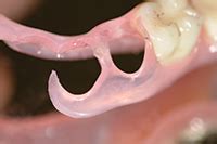 Flexible Partial Denture Variations: The Use of Circumferential ...