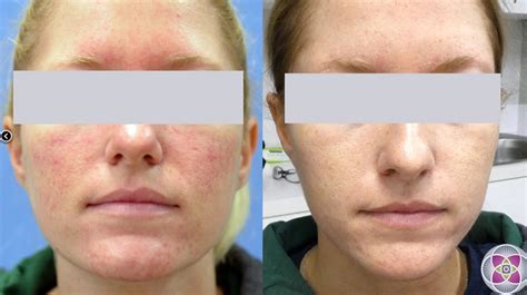 CO2 Fractional Laser For Rosacea – Cosmetic Surgery Tips