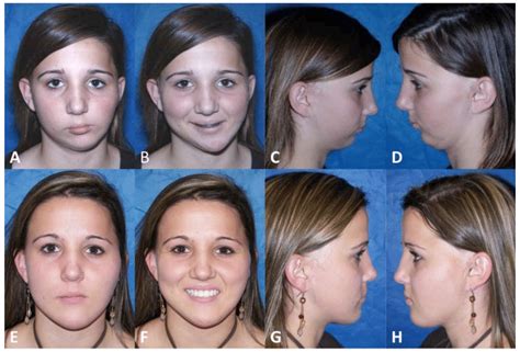 Hemifacial Microsomia | Dr. Larry M. Wolford, DMD