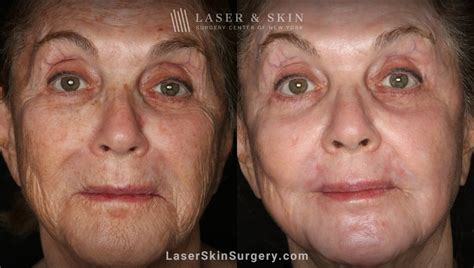 3 Reasons to Consider Laser Treatments for Brown Spots - Laser NY