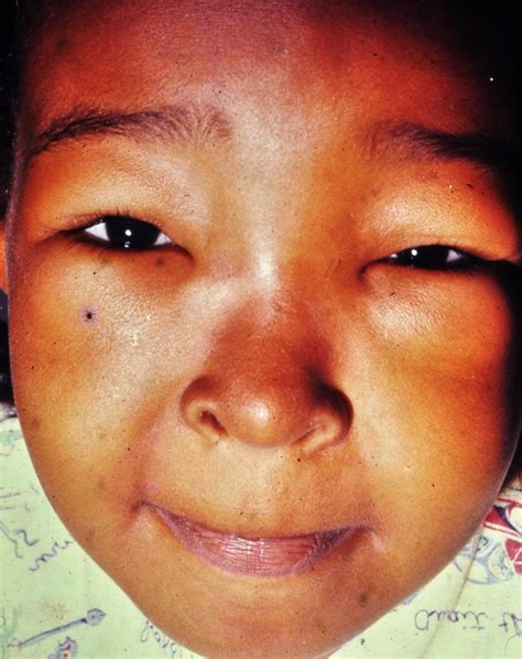 Facial Edema 1 – Clinical Eye Openers