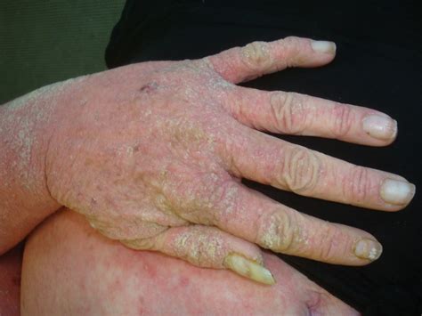 pictures of crusted scabies - pictures, photos