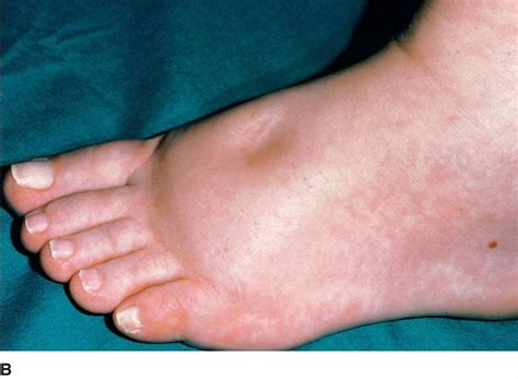 Edema: Causes Symptoms And Treatment | Heidi Salon