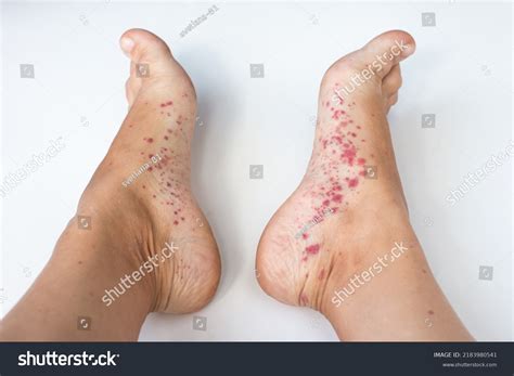 900 Shingles Foot Images, Stock Photos & Vectors | Shutterstock