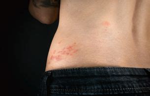 Risk of Shingles Complications by Age