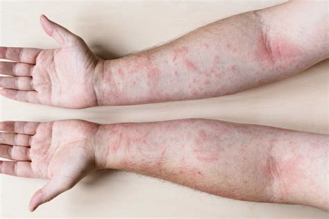 Causes Of Itching Without Rash Or Hives at Mee Gorman blog