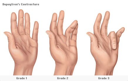 Dupuytren's Contracture Treatment in Singapore - Singapore Sports And ...