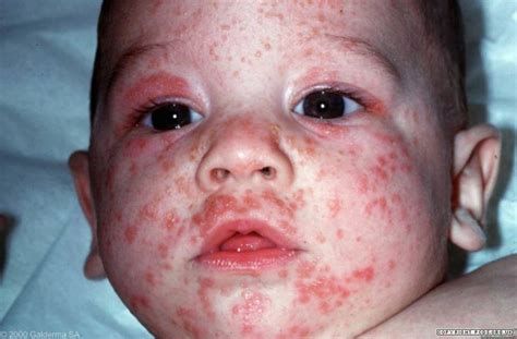 scabies in babies - pictures, photos