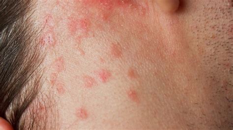 Itchy Red Rash On Scalp And Neck | Allergy Trigger