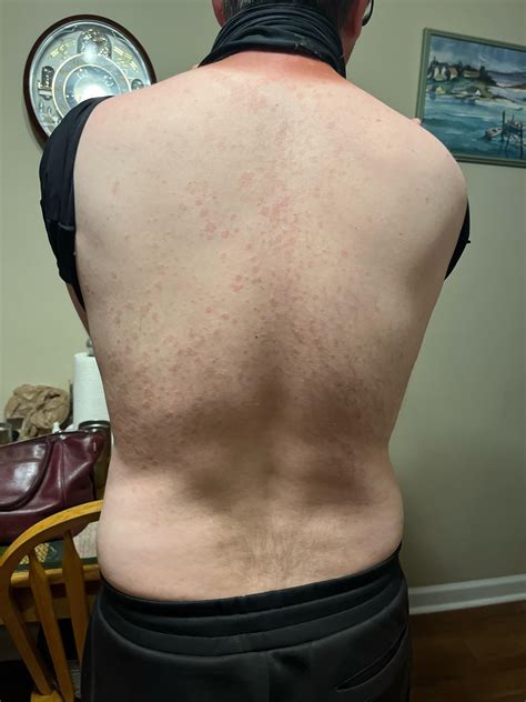 Hives rash on back - what is it??? : r/DermatologyQuestions