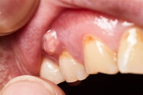 Gum Blister: 7 Common Causes (& What to Do) - Tua Saúde