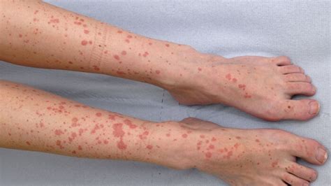 Vasculitis: Symptoms, Causes And Best Treatment Methods